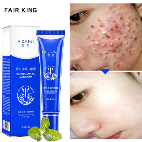Facial care Acne Treatment Blackhead Remova Tea Tree Cleansing  Acne Cream Oil Control Shrink Pores Acne Scar Face Whitening
